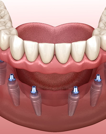 Illustration of full implant dentures in North Attleboro, MA