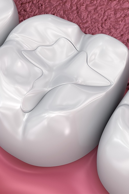 Animated smile after tooth colored filling restorative dentistry treatment