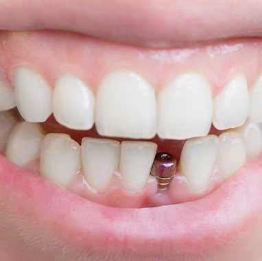 A placed dental implant without its final restoration