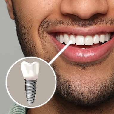 A photo highlighting a bearded man’s complete dental implant