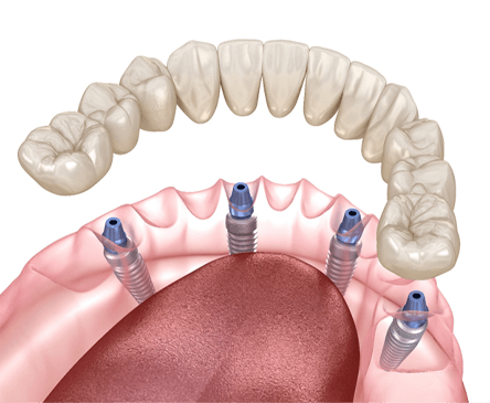 Digital illustration of All-On-4 dental implants