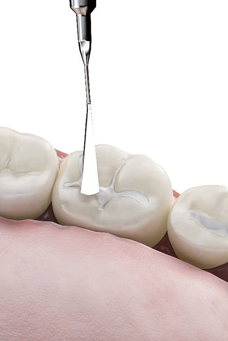 Dental instrument applying resin to enamel for dental bonding