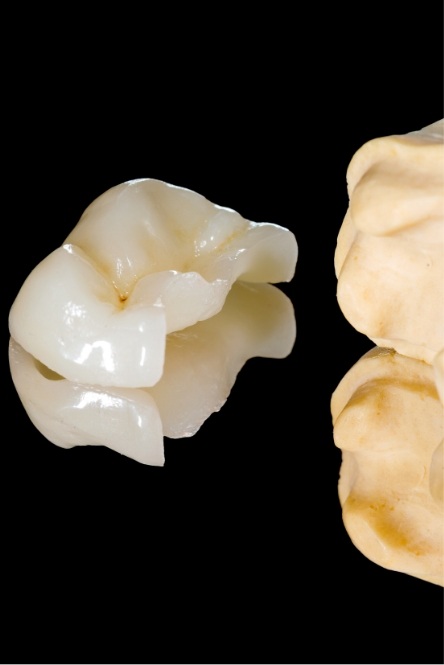 Metal free dental crown restorations