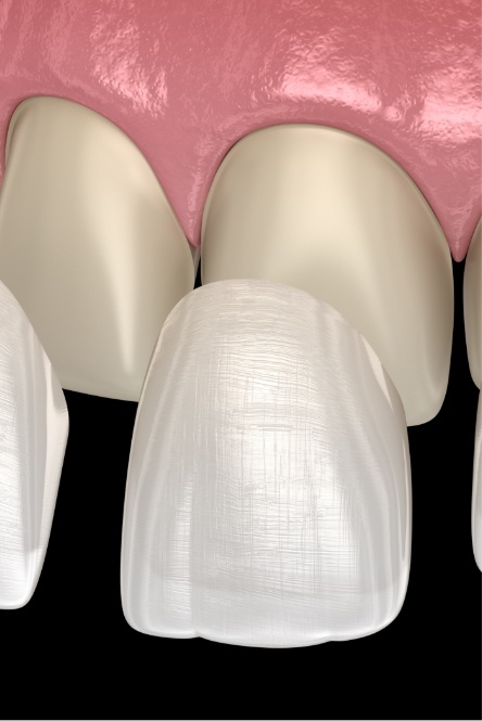 Animated smile during dental bonding treatment