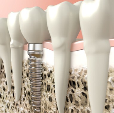 Digital illustration of a dental implant