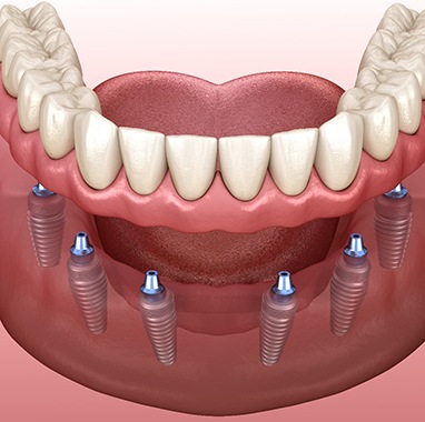 Digital illustration of implant dentures