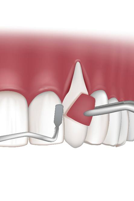 Illustration of gum grafting in North Attleboro, MA for upper arch
