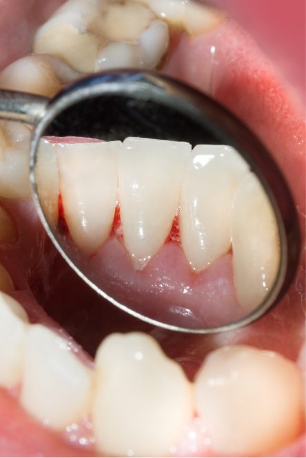 Closeup of smile with damaged gums before periodontal therapy
