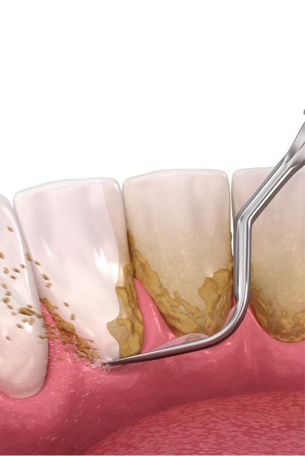 Animated smile during scaling and root planing treatment