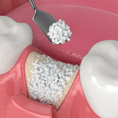 Digital illustration of bone graft