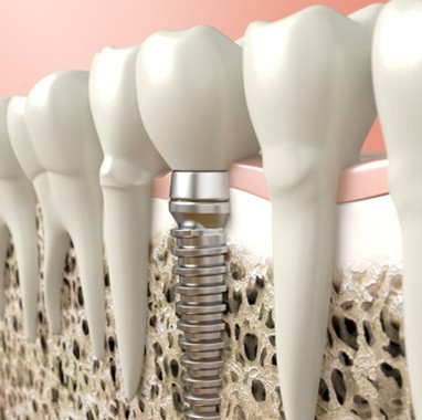 Digital illustration of dental implant