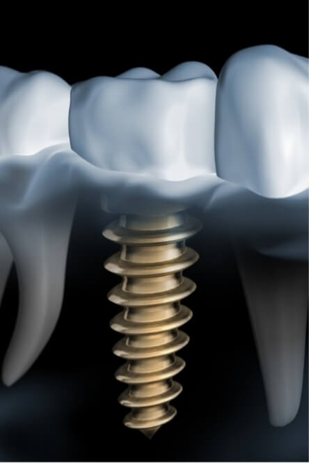 Animated smile during dental implant supported dental restoration placement
