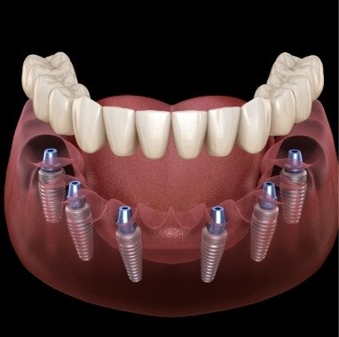 Dentist and patient looking at model comparing a dental implant tooth to a natural tooth