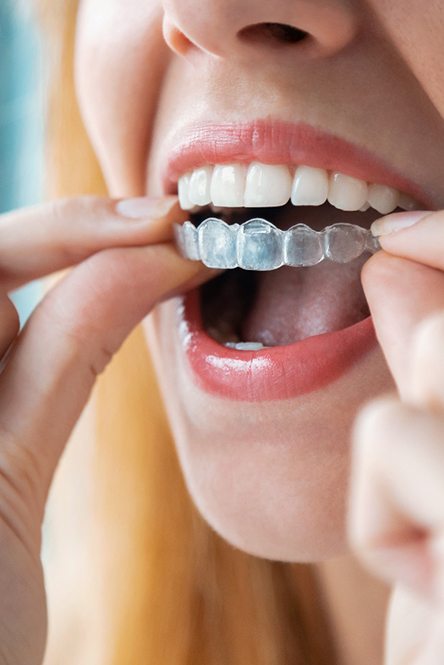 Young woman putting on her Invisalign aligner