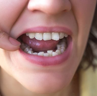 Closeup of a crooked smile