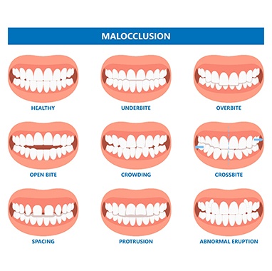 diagram of a series of bites
