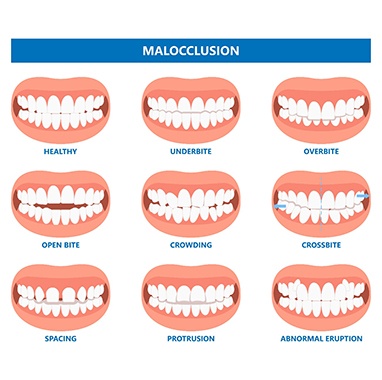 diagram of a series of bites