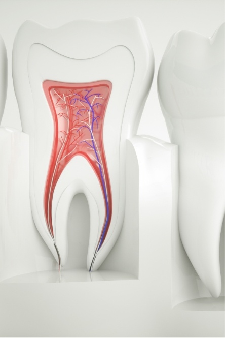 Model of he inside of tooth demonstrating root canal therapy