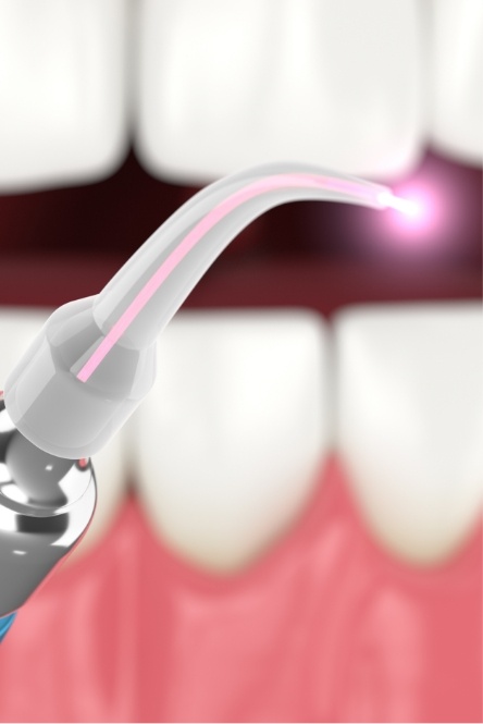 Soft tissue laser dentistry tool