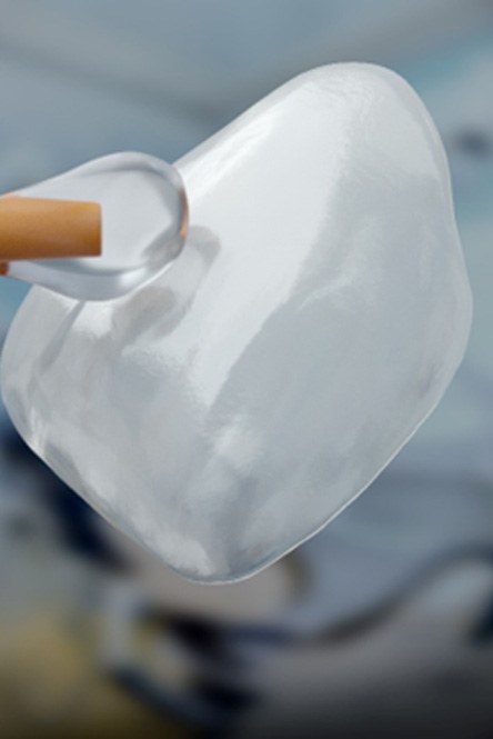 Close up of adhesive material being applied to a dental veneer