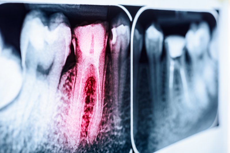 An X-ray of a tooth that needs a root canal